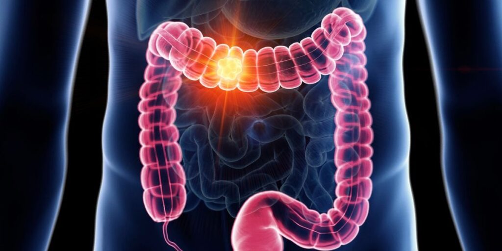 Understanding Colon and Rectal Cancer